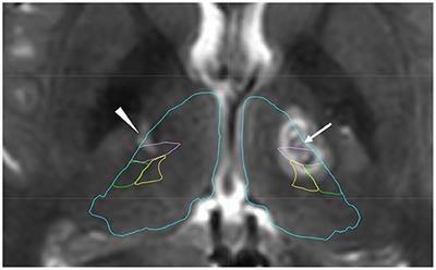 Case Report: Long-Term Suppression of Paroxysmal Kinesigenic Dyskinesia After Bilateral Thalamotomy
